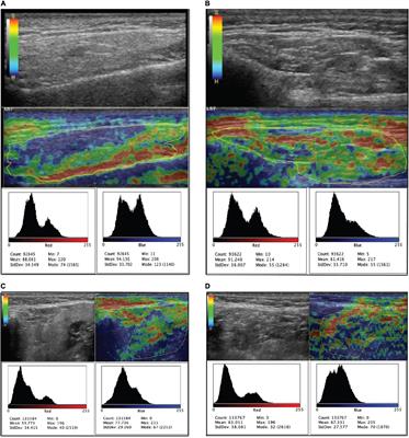 A Novel Technique for the Evaluation and Interpretation of Elastography in Salivary Gland Involvement in Primary Sjögren Syndrome